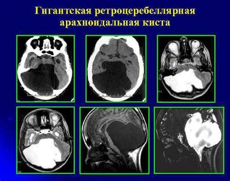 Альтернативные способы лечения арахноидальной кисты: возможности консервативной терапии