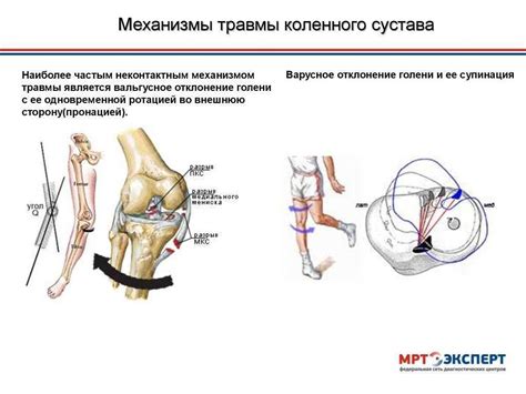 Альтернативы гипсу при повреждении связок колена