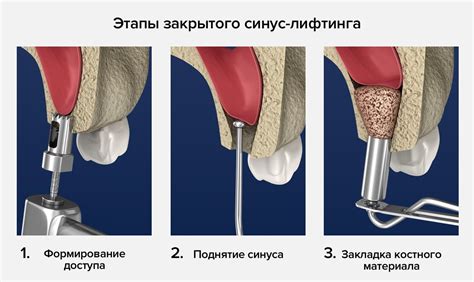 Важные моменты после синус лифтинга