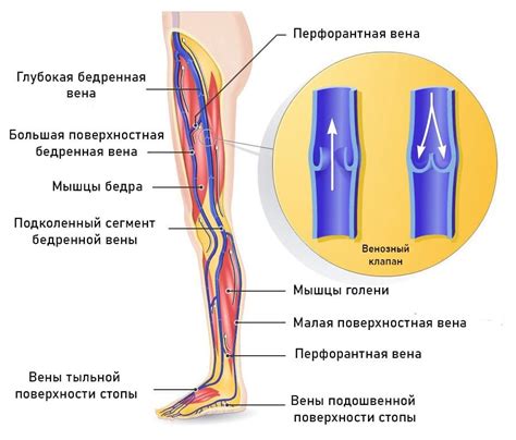 Варикозное расширение вен