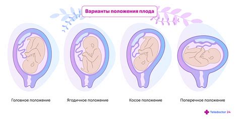 Взаимодействие факторов, определяющих положение плода в утробе матери