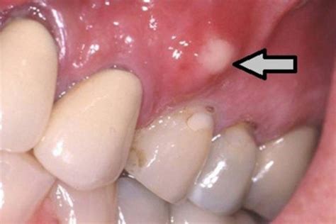 Возможные заболевания, вызывающие образование шарика на десне
