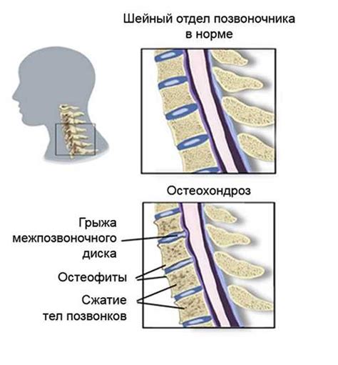 Возможные проблемы с обонянием и головокружение при шейном хондрозе