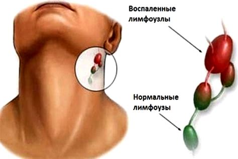 Воспаление лимфоузла: симптомы и типичные причины