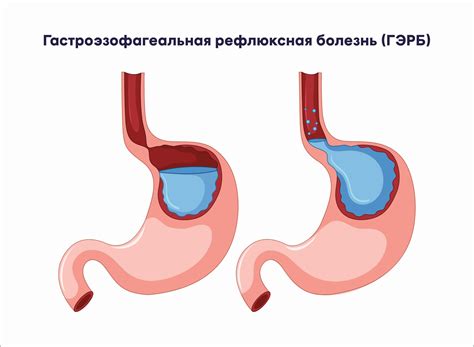 Гастроэзофагеальная рефлюксная болезнь – одна из причин тошноты