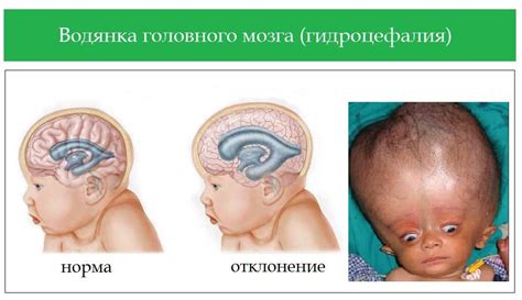 Гидроцефалия: что это?