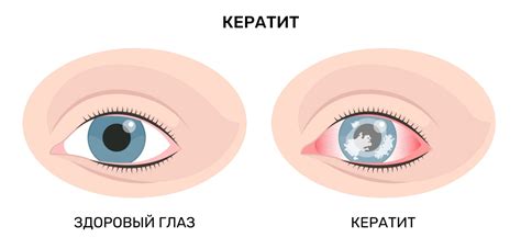 Глазные инфекции и заболевания