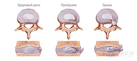 Диагностика грыжи и методы лечения