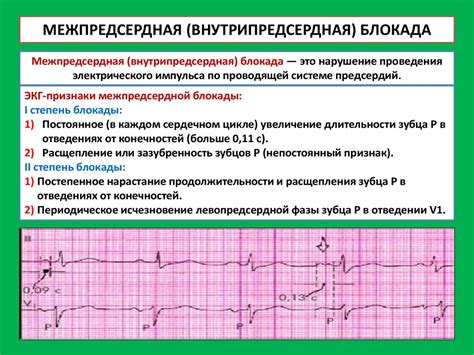 Диагностика нарушений проводимости на ЭКГ