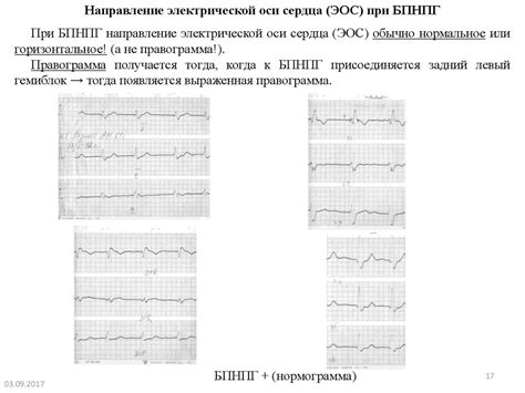 Диагностика нарушения внутрижелудочковой проводимости