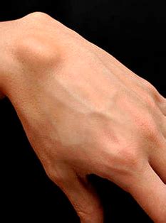 Жировик на руке: чем он опасен и как распознать?