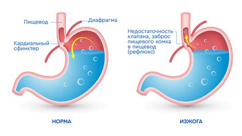 Изжога: что это такое?