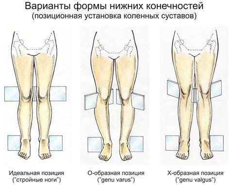 Излишняя масса тела и деформация суставов