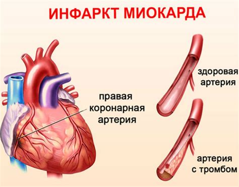 Инфаркт миокарда