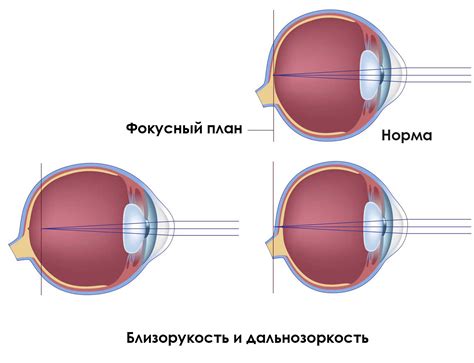 Исчезновение дефектов зрения