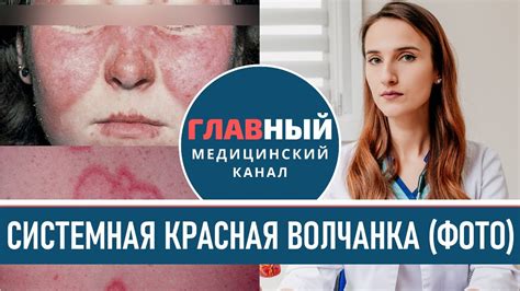 Как отличить генетическую форму красной волчанки от неинфекционной