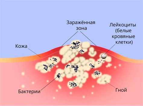 Как правильно диагностировать гнойнички