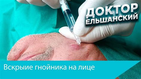 Как предотвратить появление гнойника на ране?