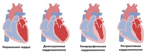 Кардиомиопатия