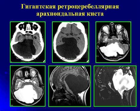 Когда требуется операция для удаления арахноидальной сумки: основные показания и советы специалистов