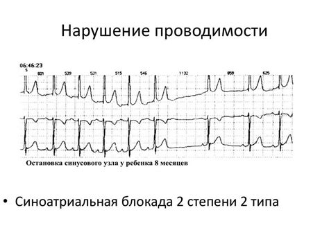 Компликации нарушения проводимости