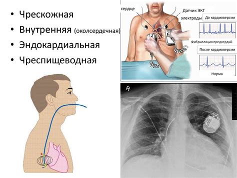 Лечение нарушений проводимости