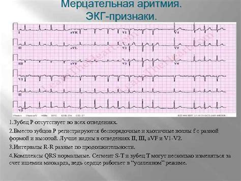 Лечение предсердного ритма на ЭКГ