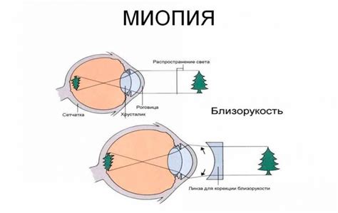 Материнская миопия и генетика