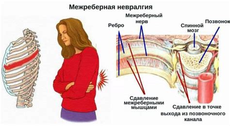 Межреберная невралгия: что это такое?