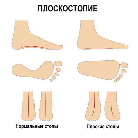 Методы лечения и коррекции плоскостопия