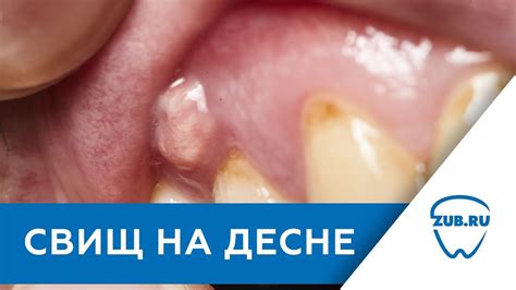 Методы лечения капюшона на десне