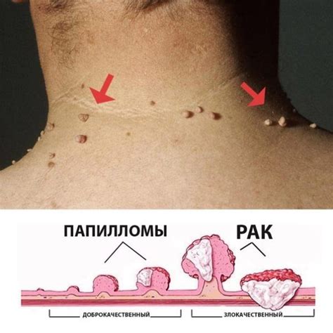 Может ли бородавка исчезнуть самостоятельно?