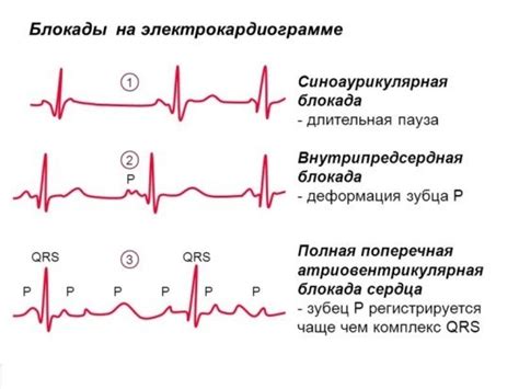 Нарушение внутрижелудочковой проводимости на электрокардиограмме