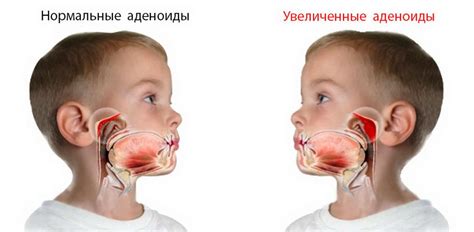 Оптимальное время удаления аденоидов в десятилетнем возрасте