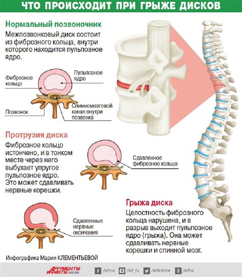 Основные принципы лечения шишки на позвоночнике