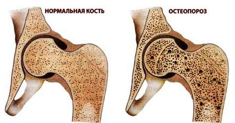 Остеопороз и заболевания костей