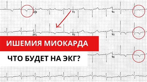 Отклонения вольтажа на ЭКГ в предсердиях: диагностическое значение