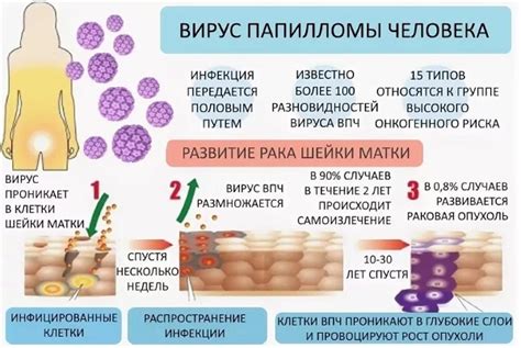 Папиллома человека 39 типа: причины и симптомы