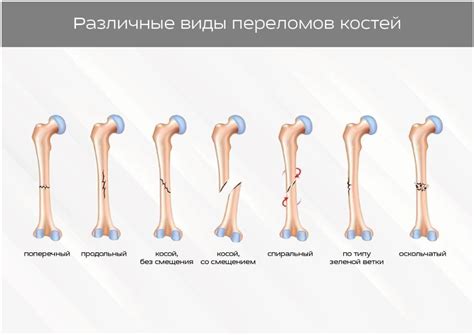 Повторный перелом кости