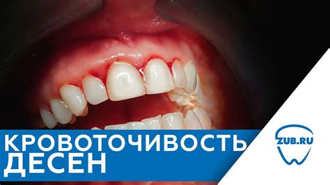 Покраснение и отечность десен