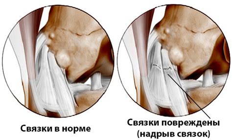 Польза и вред гипса для связок колена