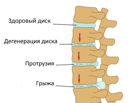 Последствия деформации диска