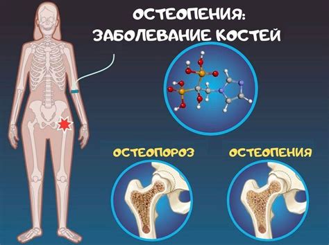 Последствия остеопороза