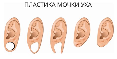 Последствия отсутствия мочки уха