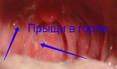 Почему возникают шишечки в горле?