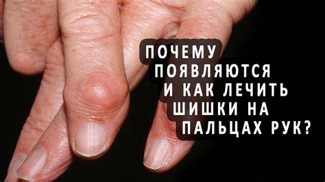 Почему возникают шишки на пальцах рук?