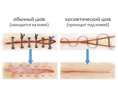 Почему нарывает шов после операции: причины и способы предотвращения