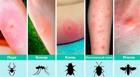 Почему некоторые индивиды испытывают аллергические реакции на укусы москитов?