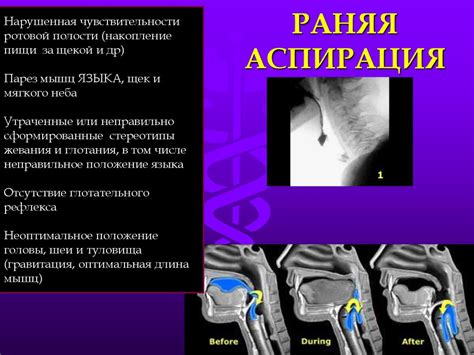 Появление нарушения функции глотания после инсульта