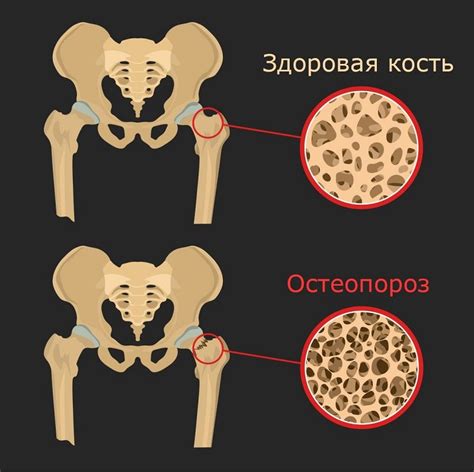 Предотвращение остеопороза и укрепление костной ткани